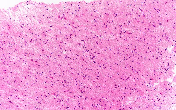 5B1 Gliomatosis Cerebri (Case 5) H&E 20X