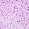 5B2 Gliomatosis Cerebri (Case 5) H&E 1 copy