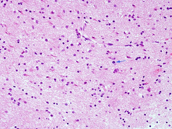 5B2 Gliomatosis Cerebri (Case 5) H&E 1 copy