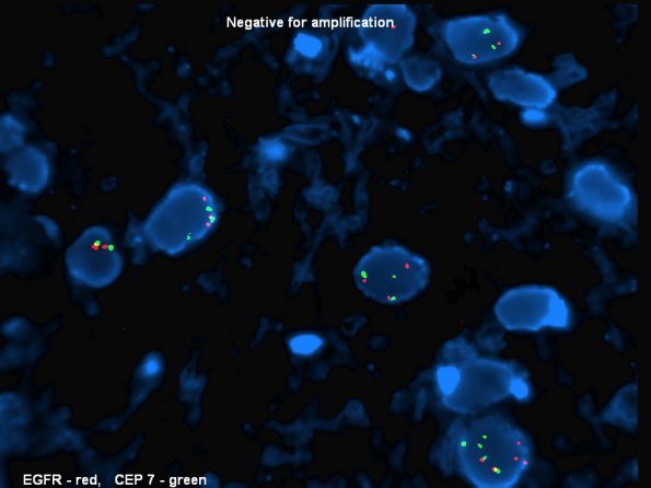 5B3 Gliomatosis Cerebri (Case 5)  Gain 7 no EGFR amplification - Copy