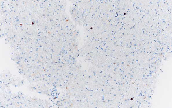 5B4 Gliomatosis cerebri (Case 5) Ki67 20X