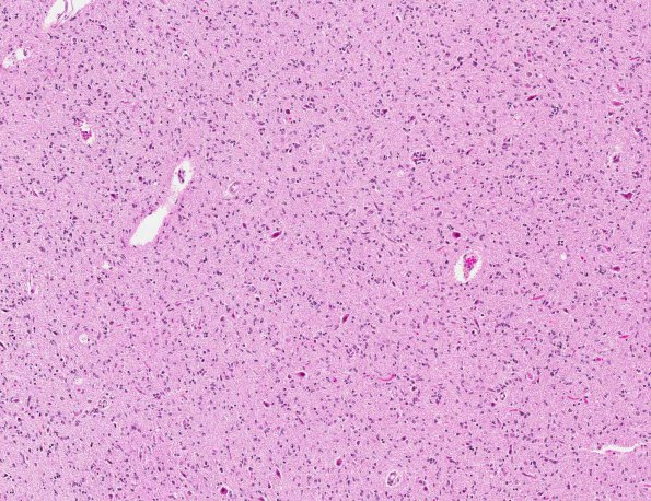 6A1 Gliomatosis cerebri (AANP 2000, Case 5) H&E X10 3