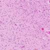 6A2 Gliomatosis cerebri (AANP 2000, Case 5) H&E X20 1