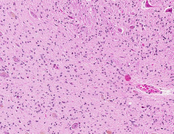 6A2 Gliomatosis cerebri (AANP 2000, Case 5) H&E X20 1