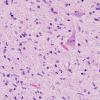 6A4 Gliomatosis cerebri (AANP 2000-05) H&E 1