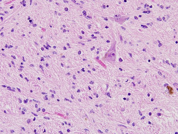 6A4 Gliomatosis cerebri (AANP 2000-05) H&E 1