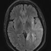 7A1 Gliomatosis cerebri (Case 7) TIRM BLADE - Copy