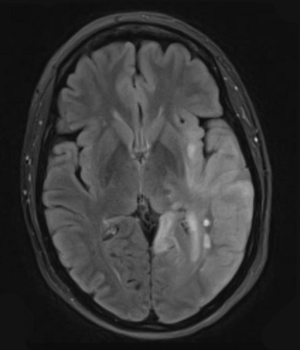 7A1 Gliomatosis cerebri (Case 7) TIRM BLADE - Copy