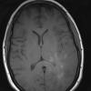 7A2 Gliomatosis cerebri (Case 7) T1 - Copy