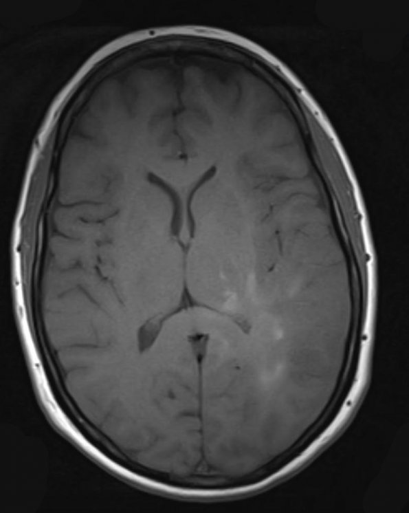 7A2 Gliomatosis cerebri (Case 7) T1 - Copy