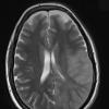 7A3 Gliomatosis cerebri (Case 7) T2 (2) - Copy