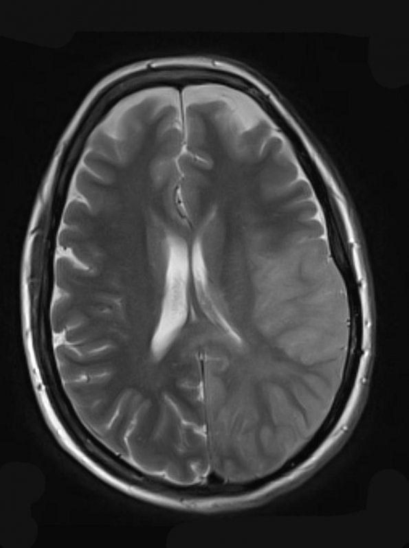 7A3 Gliomatosis cerebri (Case 7) T2 (2) - Copy