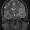 7A4 Gliomatosis cerebri (Case 7) T2 - Copy