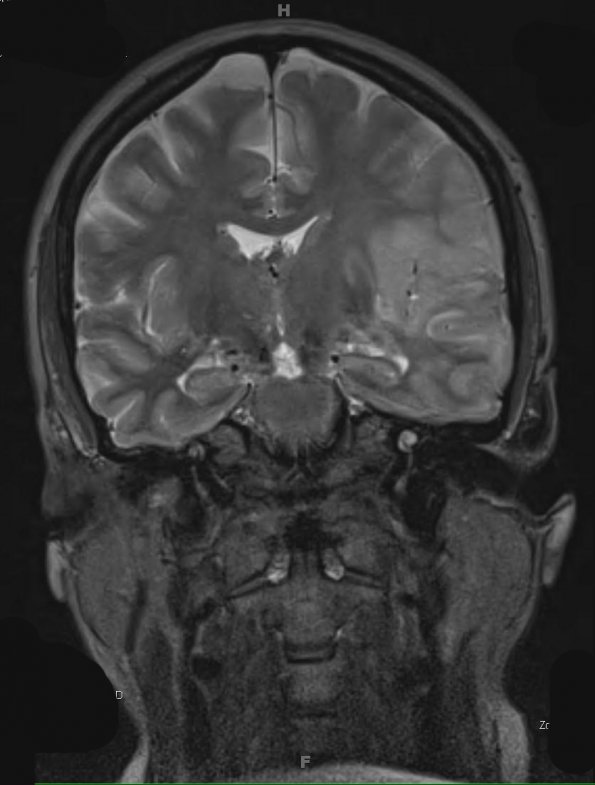 7A4 Gliomatosis cerebri (Case 7) T2 - Copy