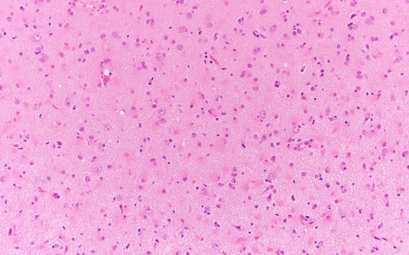 7B1 Gliomatosis cerebri (Case 7) B1 H&E