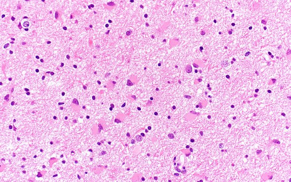 7B2 Gliomatosis cerebri (Case 7) B1 H&E