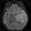 8A1 Gliomatosis cerebri (Case 8) FLAIR - Copy