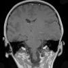 8A2 Gliomatosis cerebri (Case 8) T1 W - Copy