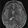 8A3 Gliomatosis cerebri (Case 8) T2 - Copy