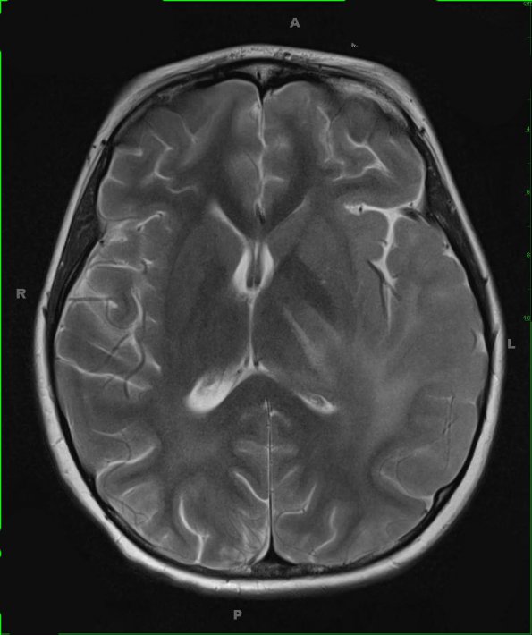 8A3 Gliomatosis cerebri (Case 8) T2 - Copy