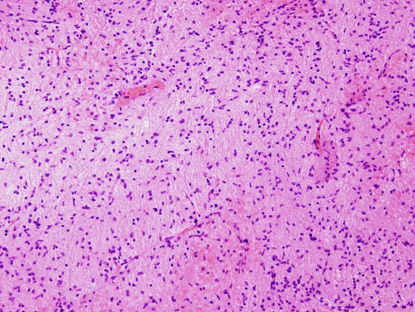 8B1 Gliomatosis cerebri (Case 8) H&E 1I