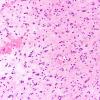 8B2 Gliomatosis cerebri (Case 8) B1 H&E 20X