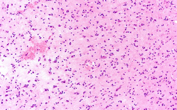 8B2 Gliomatosis cerebri (Case 8) B1 H&E 20X