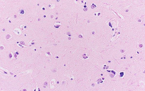 9A1 Gliomatosis (ASPC Case 2-F96) H&E 40X 4