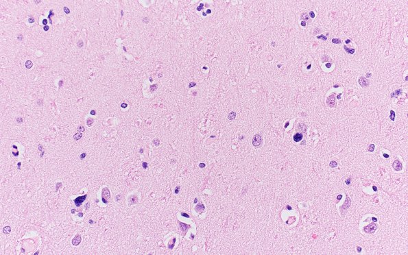 9A2 Gliomatosis (ASPC Case 2-F96) H&E 40X 3