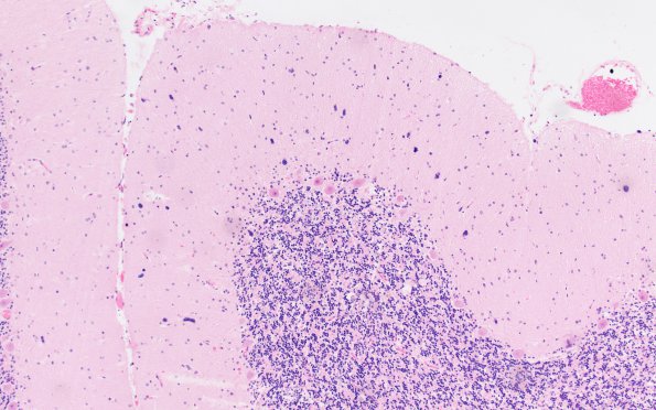 9A3 Gliomatosis (ASPC Case 2-F96) H&E 10X