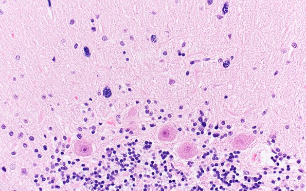 9A4 Gliomatosis (ASPC Case 2-F96) H&E 40X