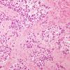 10A Gliosarcoma (Case 10) H&E