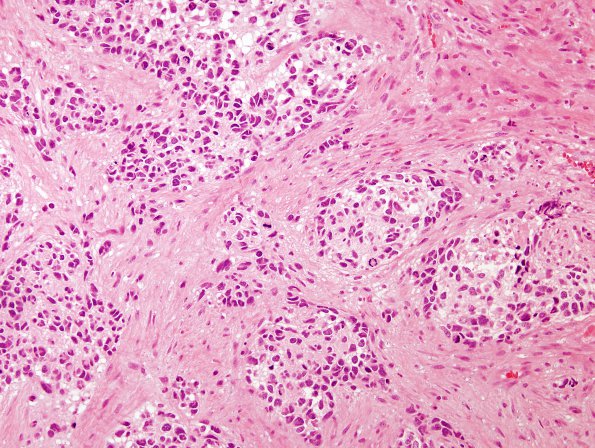 10A Gliosarcoma (Case 10) H&E