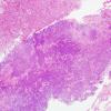 11A1 Gliosarcoma (Case 11) H&E 12