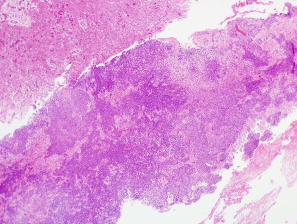 11A1 Gliosarcoma (Case 11) H&E 12