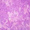 11A2 Gliosarcoma (Case 11) H&E 8