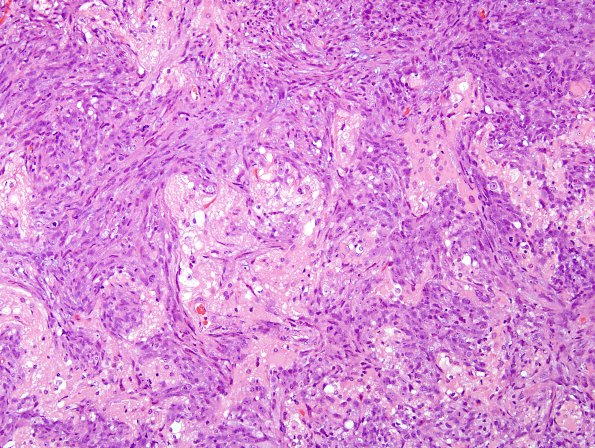 11A2 Gliosarcoma (Case 11) H&E 8