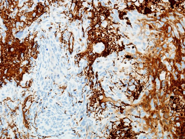 11B2 Gliosarcoma (Case 11) GFAP 2