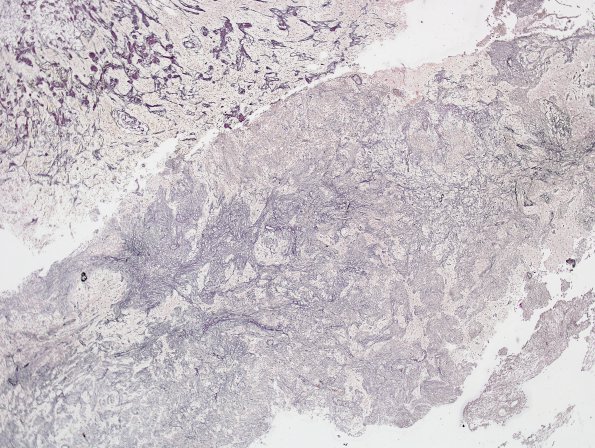 11C1 Gliosarcoma (Case 11) Retic 4X