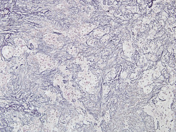 11C2 Gliosarcoma (Case 11) Retic 2