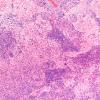 11D1 Gliosarcoma (Case 11) H&E 10X