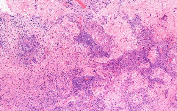 11D1 Gliosarcoma (Case 11) H&E 10X