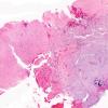 12A1 Gliosarcoma (Case 12) H&E 2X copy