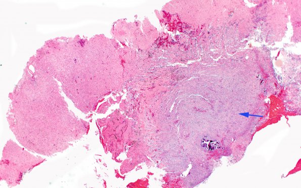 12A1 Gliosarcoma (Case 12) H&E 2X copy