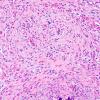 12A2 Gliosarcoma (Case 12) H&E sarcoma area 8