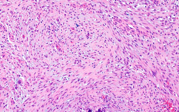 12A2 Gliosarcoma (Case 12) H&E sarcoma area 8