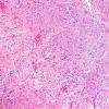 12A2 Gliosarcoma (Case 12) H&E sarcoma area 10X