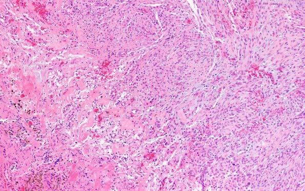 12A2 Gliosarcoma (Case 12) H&E sarcoma area 10X