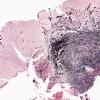 12C1 Gliosarcoma (Case 12) Retic sarcoma area 2X