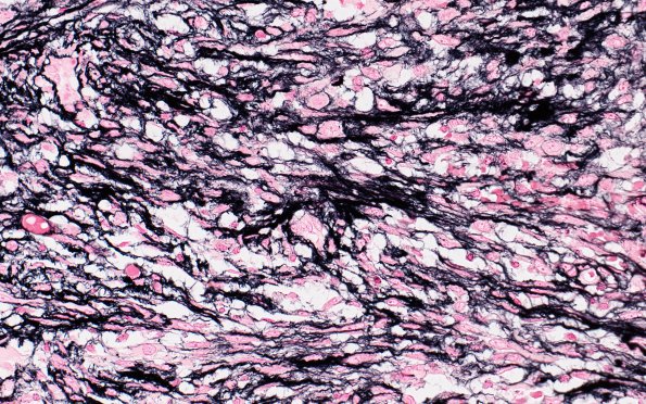 12C2 Gliosarcoma (Case 12) Retic sarcoma area 1